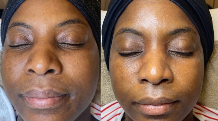 Voor- en nafoto's van een vrouw met een donkere huidskleur. Hierop is te zien dat haar teint er helderder en egaler uitziet na een huidverzorging's behandeling bij Estacy Skin Clinic.