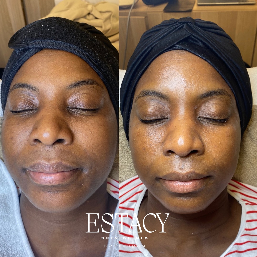 Voor- en nafoto's van een vrouw met een donkere huidskleur. Hierop is te zien dat haar teint er helderder en egaler uitziet na een huidverzorging's behandeling bij Estacy Skin Clinic.